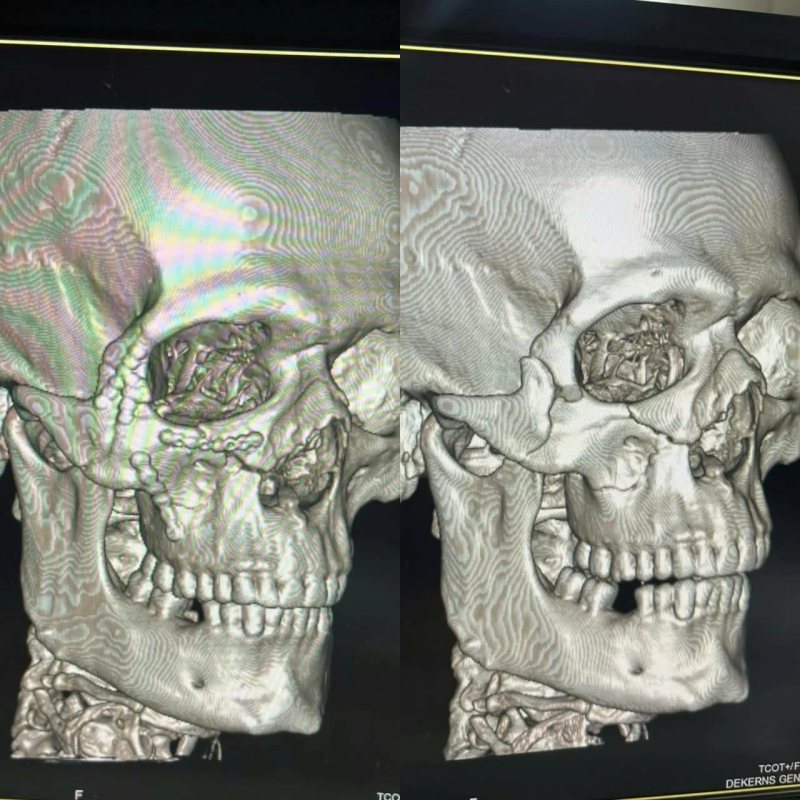 نجاح جراحة دقيقة لتثبيت كسور معقدة بالوجه ومحجر العين بمستشفى دكرنس في الدقهلية